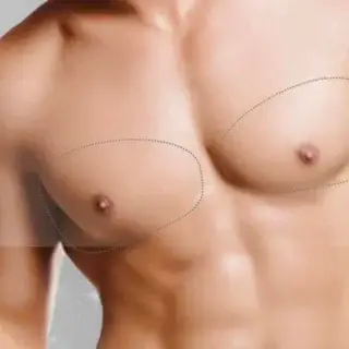Gynecomastia Surgery